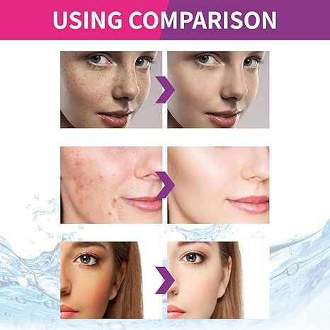Spot Fading Urea ,Dark Spot Reducing,ππ‘π’πππ§π’π§π and π
π«πππ€π₯π Removal Cream