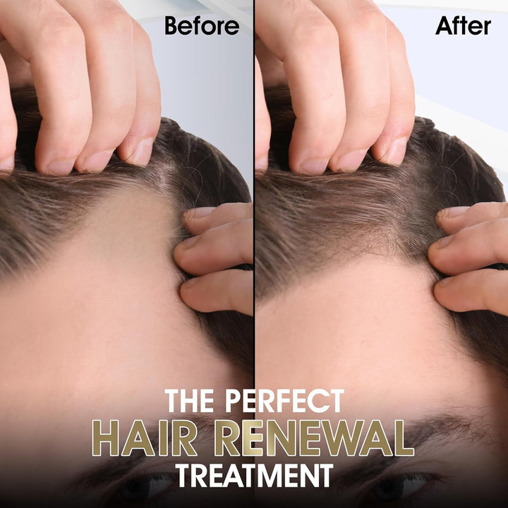 Derma Roller- 540 Titanium Needle (0.5mm)