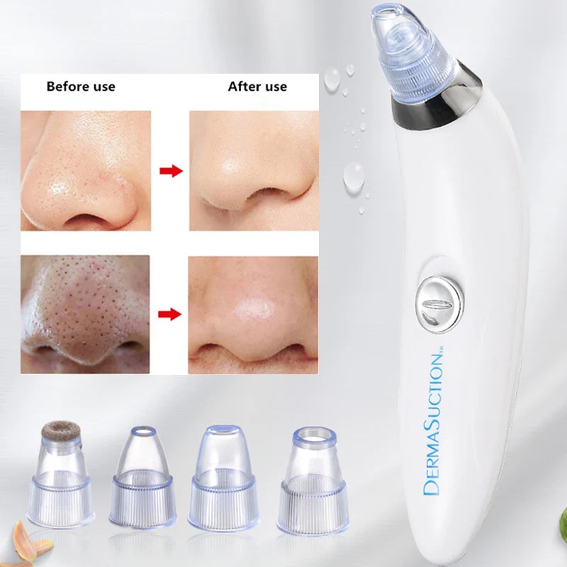 Derma Suction Blackhead Remover Device