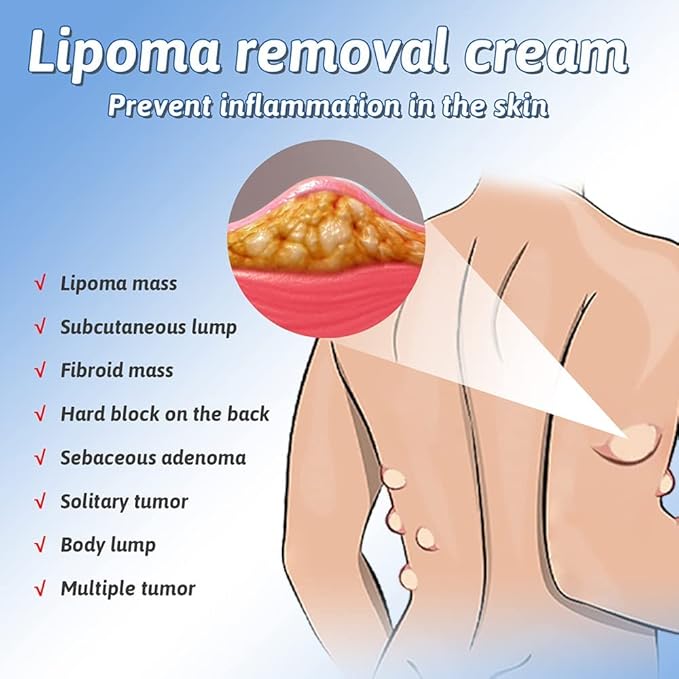 South Moon Lipoma Removal Cream