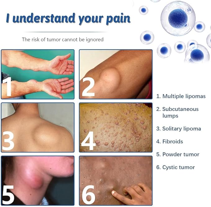 South Moon Lipoma Removal Cream