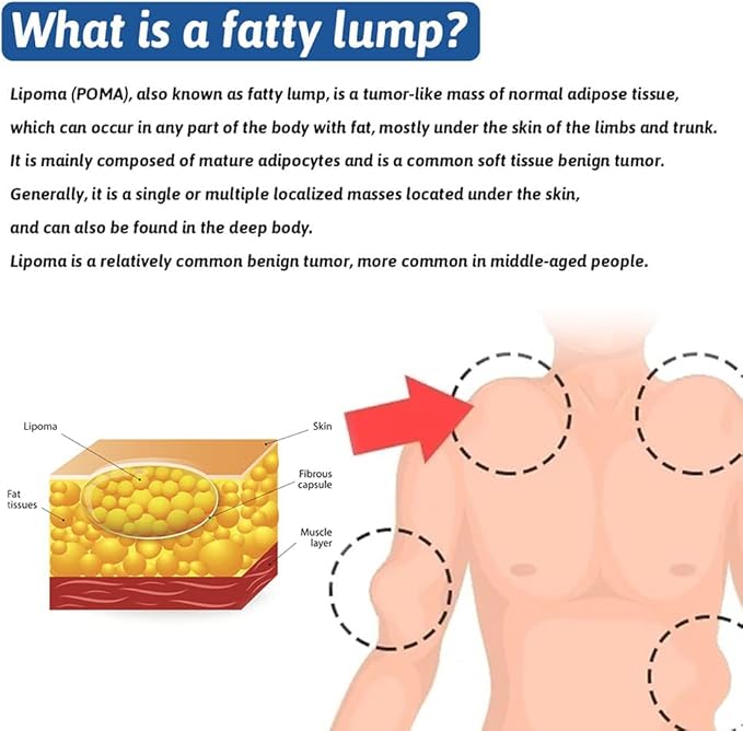 South Moon Lipoma Removal Cream