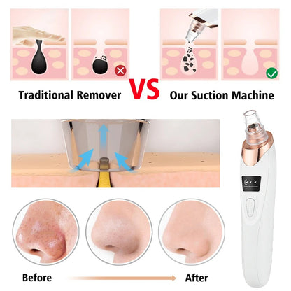 5 in 1 Rechargeable Blackheads Remover  & Cleaner