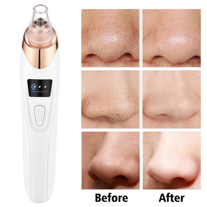 5 in 1 Rechargeable Blackheads Remover  & Cleaner